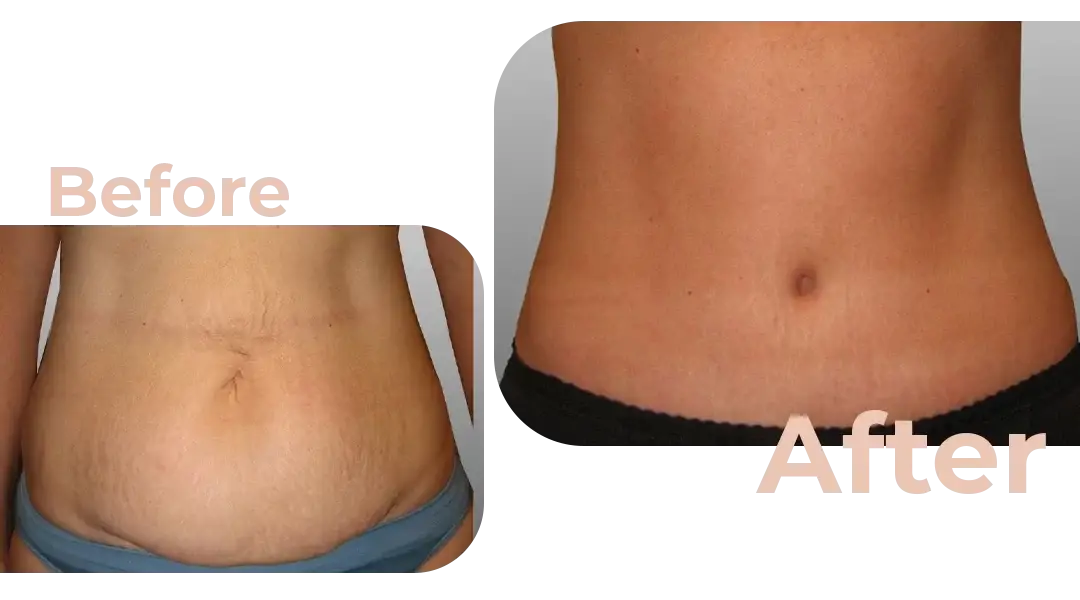 Tummy Tuck (Abdominoplasty) Surgery in Istanbul, Turkey by Avicenna Hospital