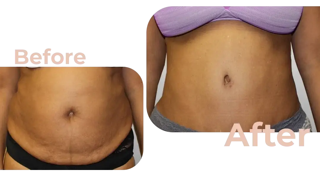 Tummy Tuck (Abdominoplasty) Surgery in Istanbul, Turkey by Avicenna Hospital