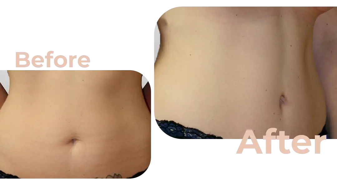 Tummy Tuck (Abdominoplasty) Surgery in Istanbul, Turkey by Avicenna Hospital