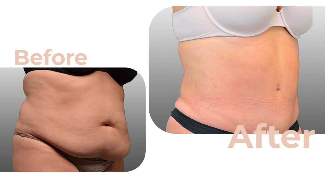 Tummy Tuck (Abdominoplasty) Surgery in Istanbul, Turkey by Avicenna Hospital