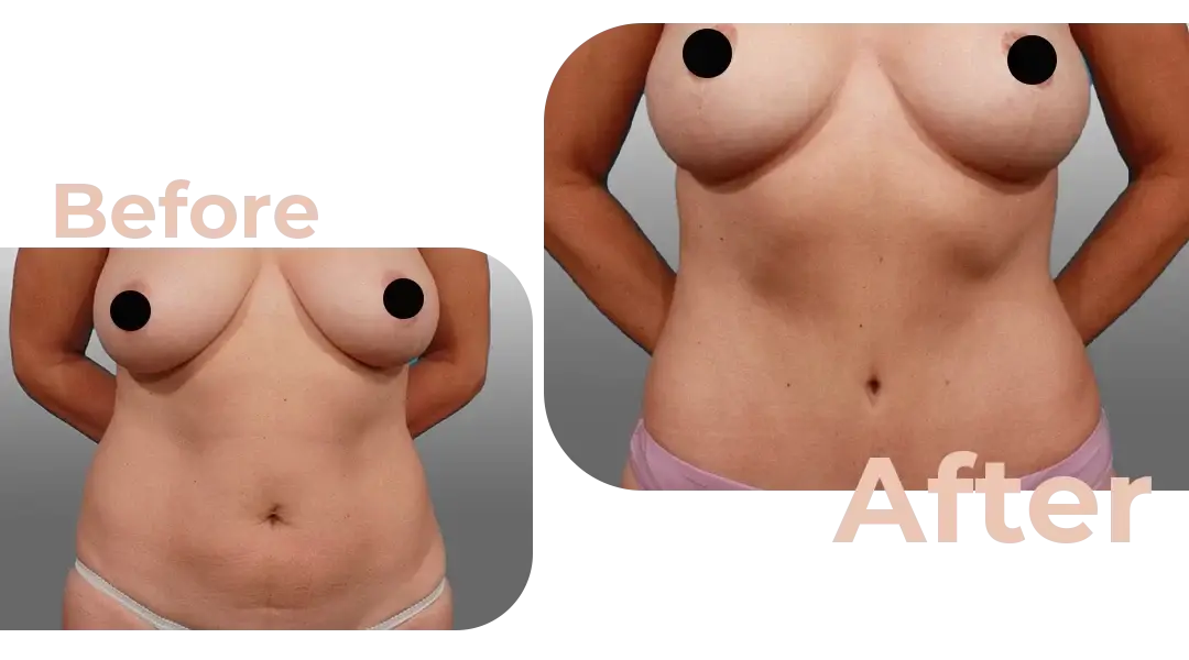 Tummy Tuck (Abdominoplasty) Surgery in Istanbul, Turkey by Avicenna Hospital