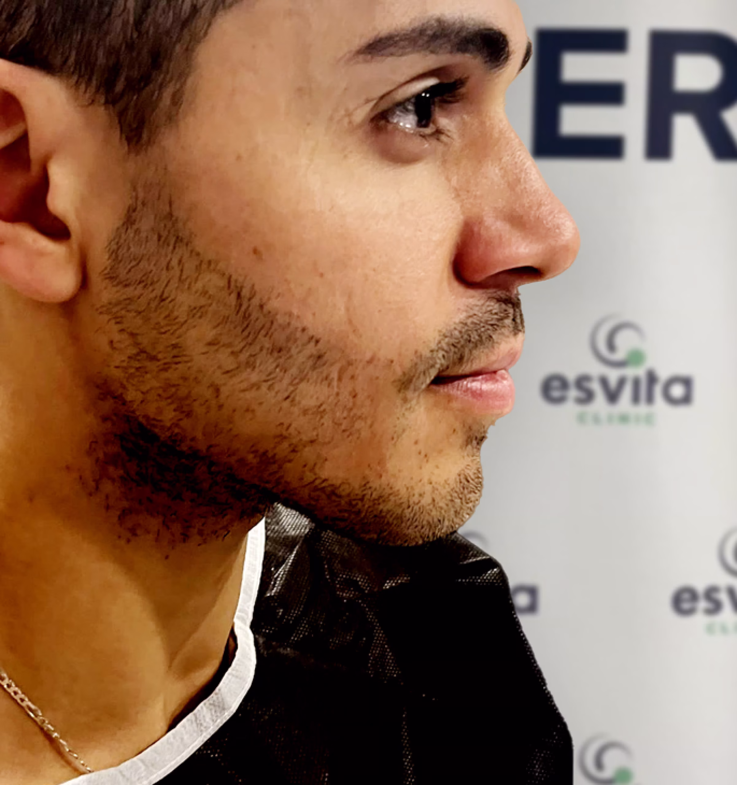 Beard Transplant in Istanbul, Turkey by Esvita Clinic — Procedure Gallery Photo