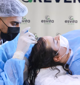 Female Hair Transplant in Istanbul, Turkey by Esvita Clinic at Esvita Clinic — Hair Restoration Surgery Procedure Abroad