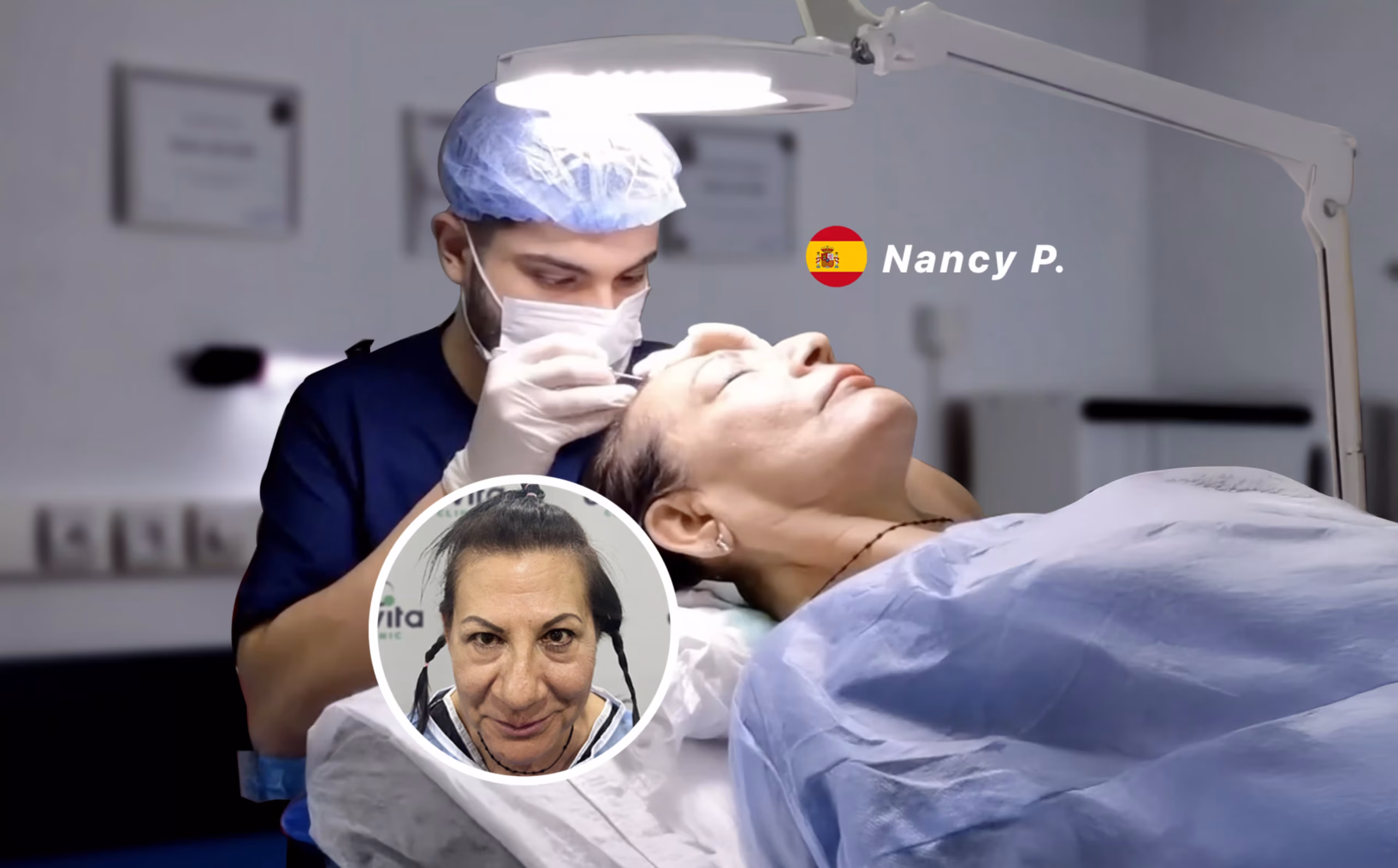 Female Hair Transplant in Istanbul, Turkey by Esvita Clinic — Procedure Gallery Photo