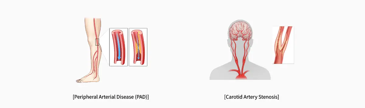 Peripheral Vascular Disease Surgery in Seoul, South Korea by Asan Medical Center — Procedure Gallery Photo