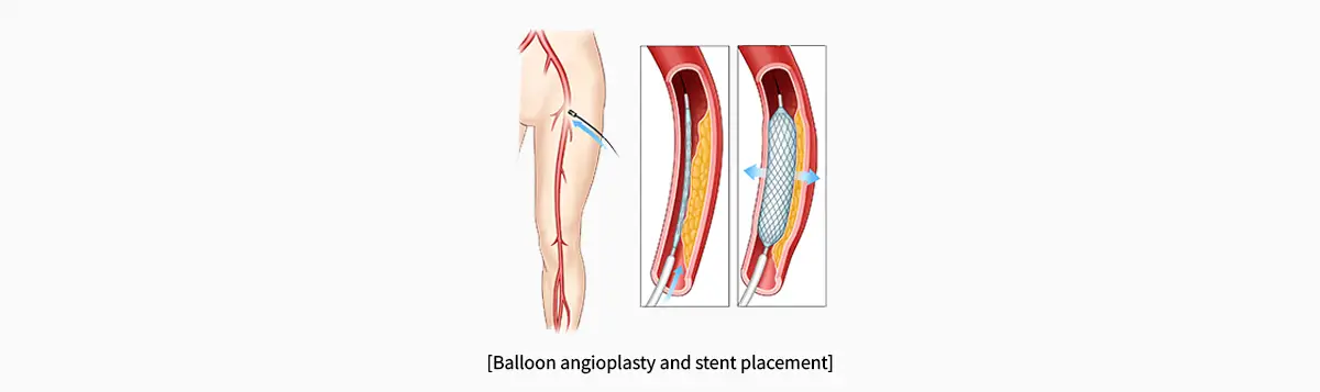 Peripheral Vascular Disease Surgery in Seoul, South Korea by Asan Medical Center — Procedure Gallery Photo