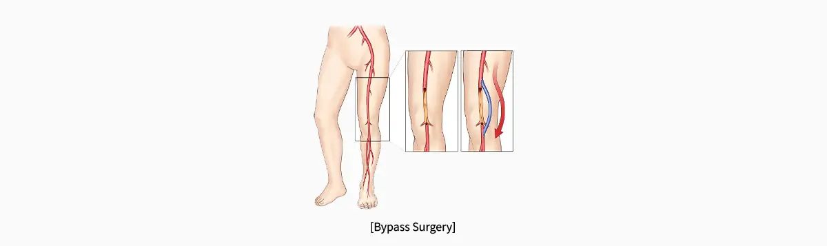 Peripheral Vascular Disease Surgery in Seoul, South Korea by Asan Medical Center — Procedure Gallery Photo