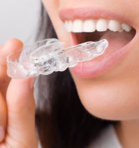 Clear Aligners in Istanbul, Turkey by Esvita Clinic at Esvita Clinic — Dentistry Procedure Abroad