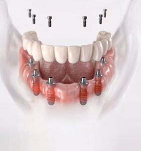 All-on-6 Treatment in Istanbul, Turkey by Esvita Clinic at Esvita Clinic — Dentistry Procedure Abroad