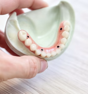 All-on-4 Treatment in Istanbul, Turkey by Esvita Clinic at Esvita Clinic — Dentistry Procedure Abroad