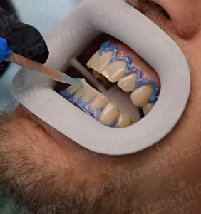 Teeth Whitening in Istanbul, Turkey by Esvita Clinic at Esvita Clinic — Dentistry Procedure Abroad