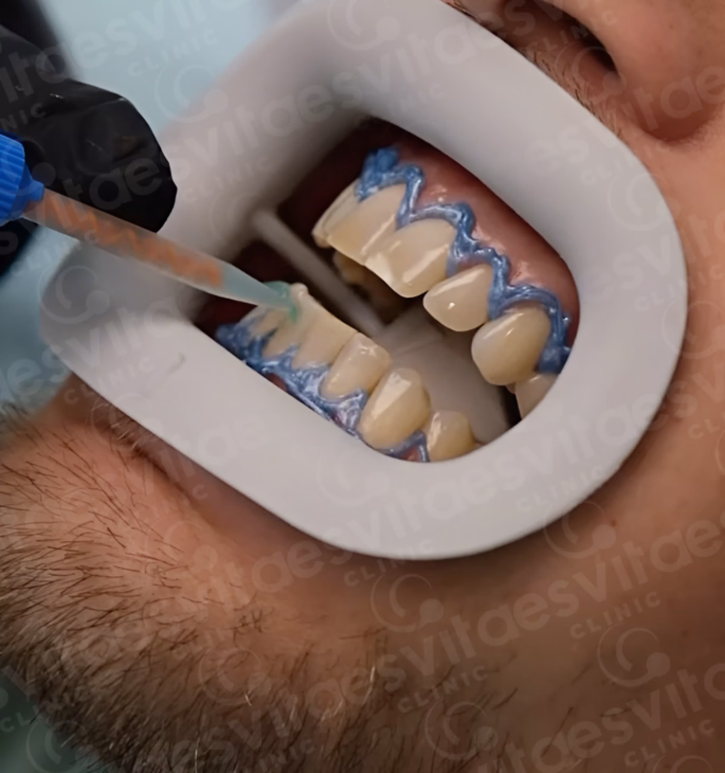 Teeth Whitening in Istanbul, Turkey by Esvita Clinic — Procedure Gallery Photo