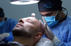 DHI Hair Transplant in Istanbul, Turkey by Esvita Clinic at Esvita Clinic — Hair Restoration Surgery Procedure Abroad