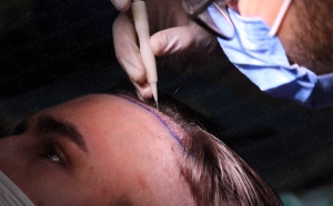 Autologous Micrograft in Istanbul, Turkey by Esvita Clinic — Hair Restoration Surgery in Turkey