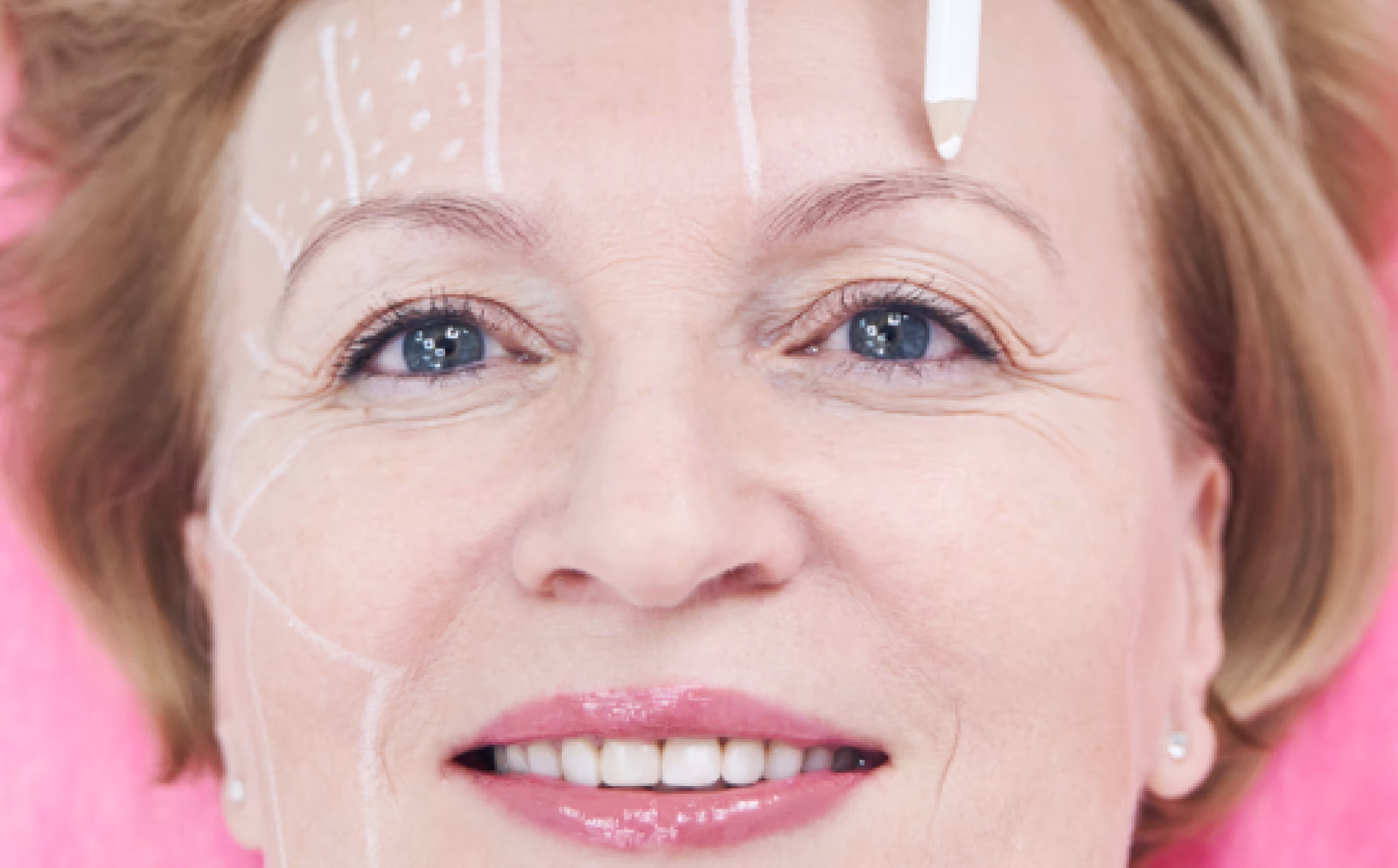 Eyebrow Lift in Istanbul, Turkey by Esvita Clinic — Procedure Gallery Photo