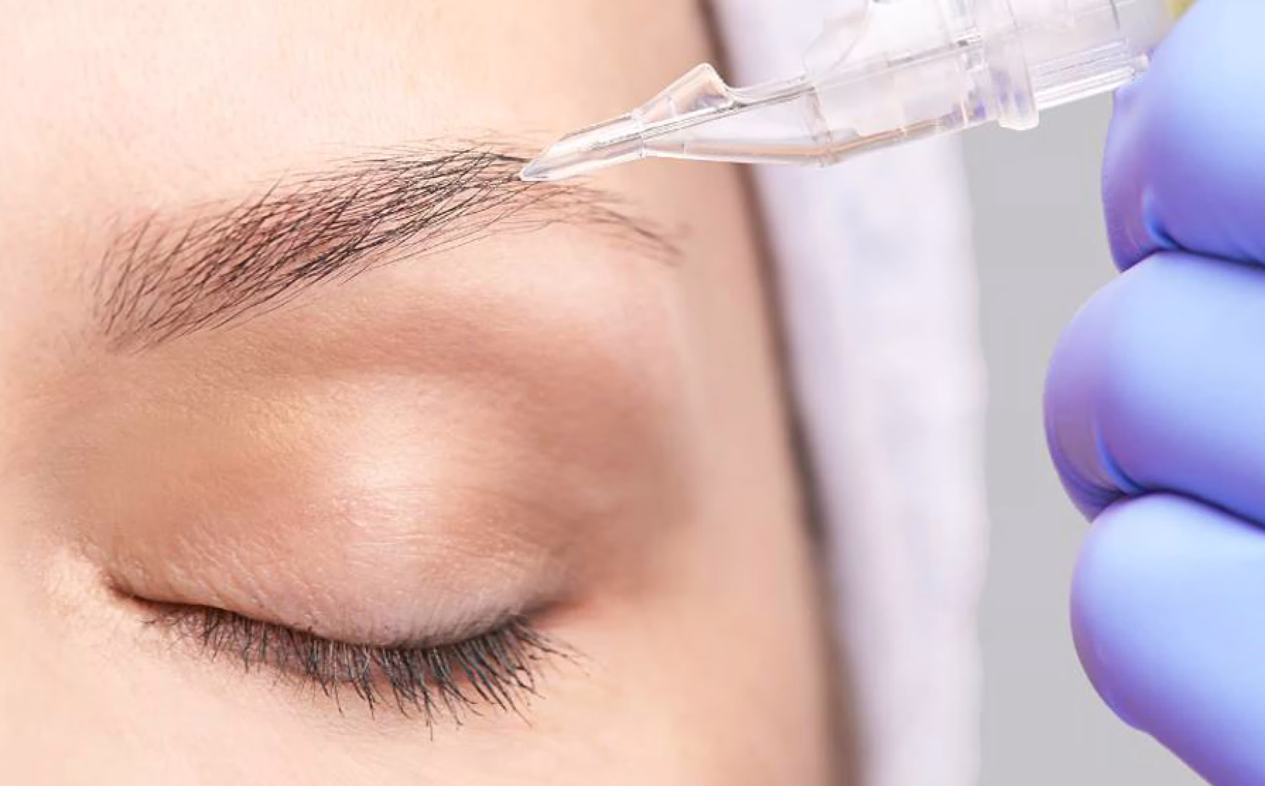 Eyebrow Transplant in Istanbul, Turkey by Esvita Clinic — Procedure Gallery Photo