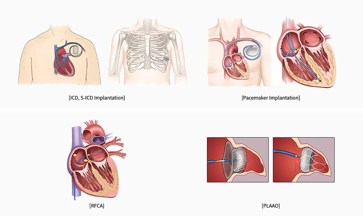 Robotic Surgery for Heart Disease in Seoul, South Korea by Asan Medical Center — Procedure Gallery Photo