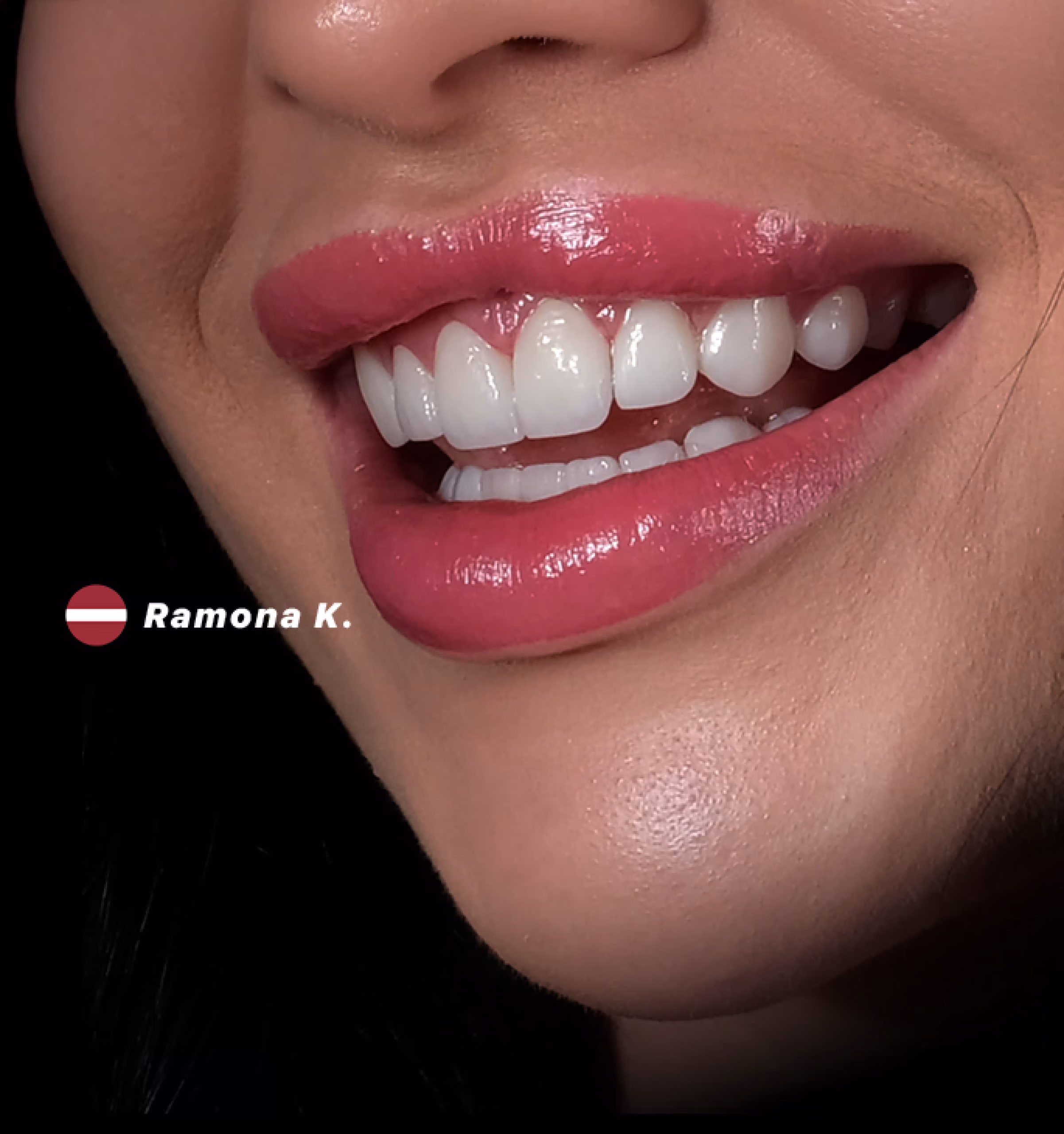 Laminate Veneers in Istanbul, Turkey by Esvita Clinic — Procedure Gallery Photo