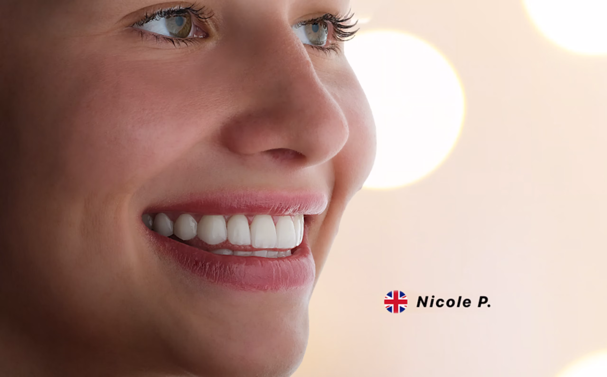 Laminate Veneers in Istanbul, Turkey by Esvita Clinic — Procedure Gallery Photo