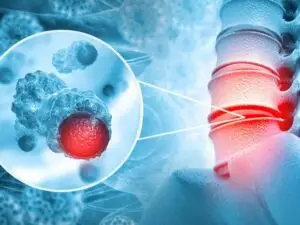 Spinal Tumour Surgery in Seoul, South Korea by Asan Medical Center — Oncology in South Korea