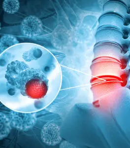 Spinal Tumour Surgery in Seoul, South Korea by Asan Medical Center — Orthopedics in South Korea