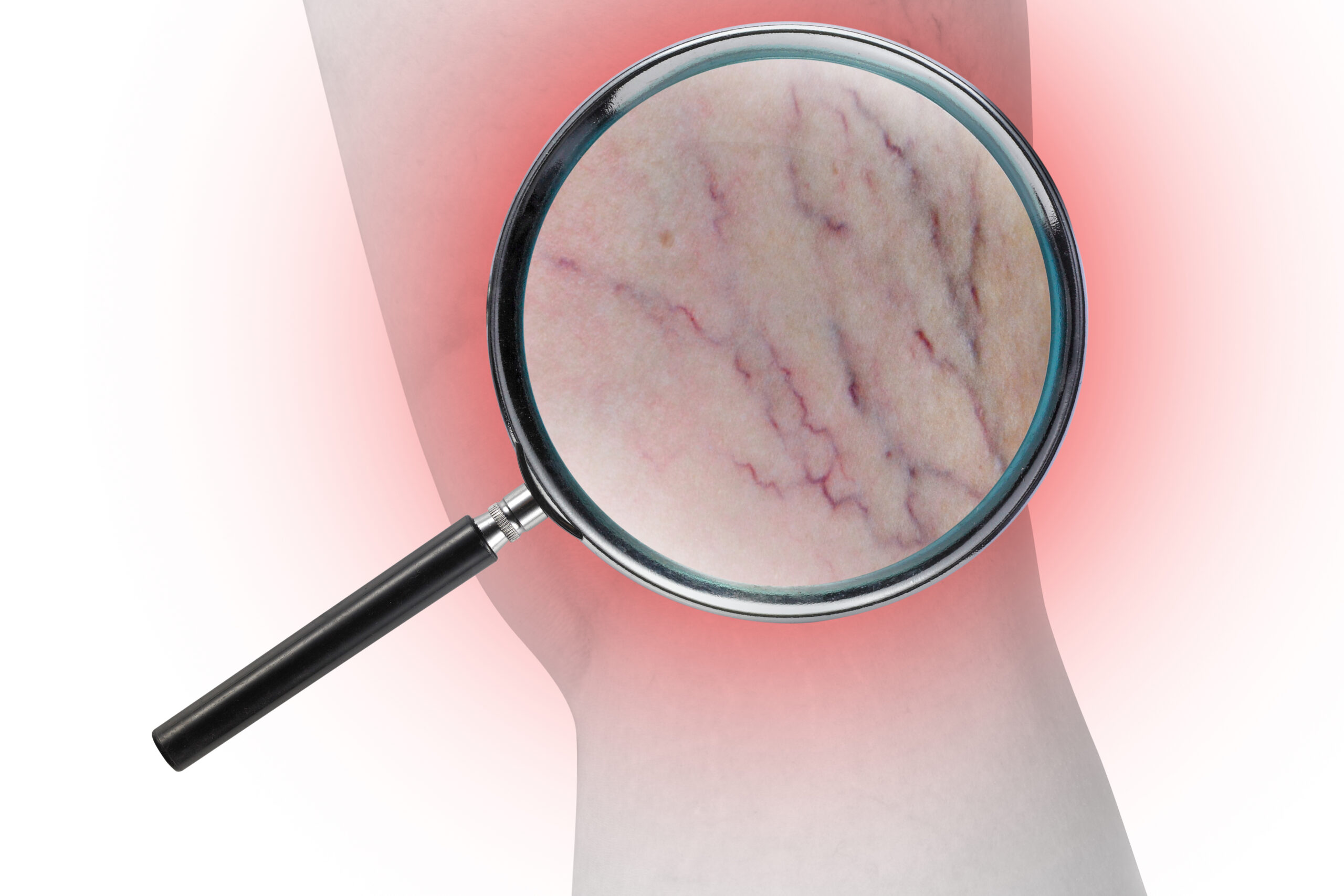 Varicose Vein Treatment in Istanbul, Turkey by Avicenna Hospital — Procedure Gallery Photo
