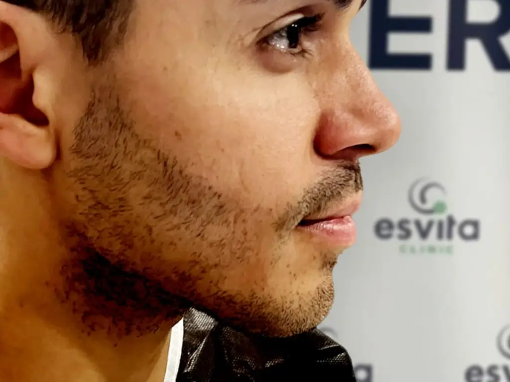 Beard Transplant in Istanbul, Turkey by Esvita Clinic — Hair Restoration Surgery Procedure in Turkey