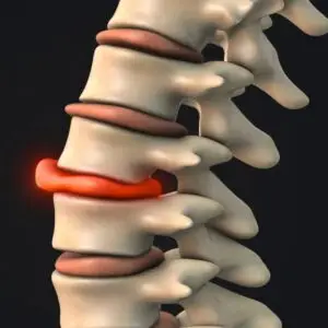 Cervical Spinal Stenosis Clinics and Procedures Abroad