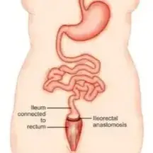 Colectomy Surgery Clinics and Procedures Abroad
