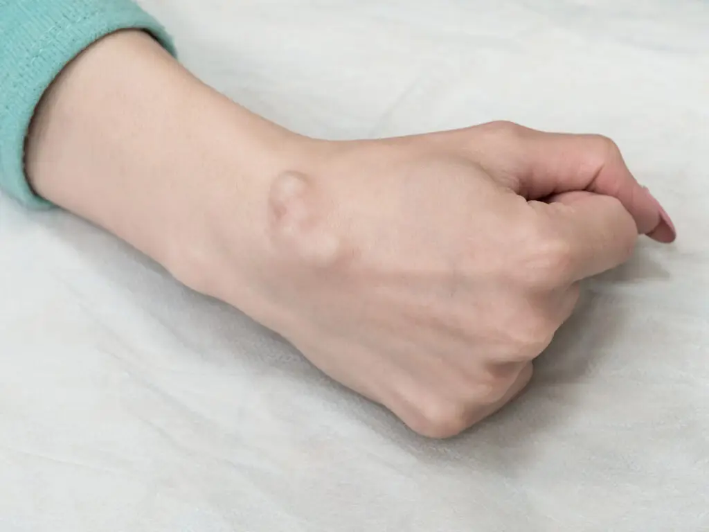 Ganglion Cyst Excision in San José, Costa Rica by Dr. Aria Ravery — Orthopedics Procedure in Costa Rica