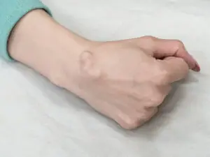 Ganglion Cyst Excision in San José, Costa Rica by Dr. Aria Ravery at Dr. Aria Ravery — Orthopedics Procedure Abroad
