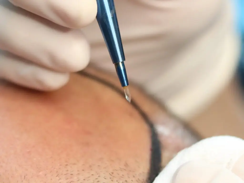 Sapphire FUE Hair Transplant in Istanbul, Turkey by Esvita Clinic — Hair Restoration Surgery Procedure in Turkey
