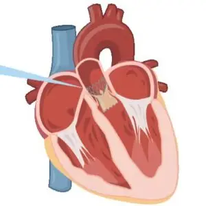 Heart Valve Repair and Replacement Clinics and Procedures Abroad