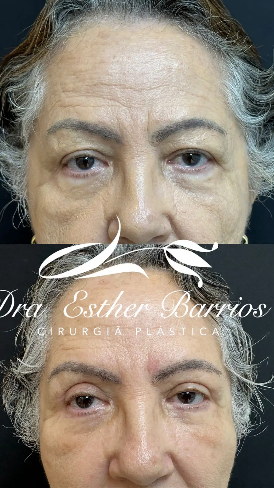 Blepharoplasty Surgery in Rio de Janeiro, Brazil by Dr. Esther Barrios — Procedure Gallery Photo