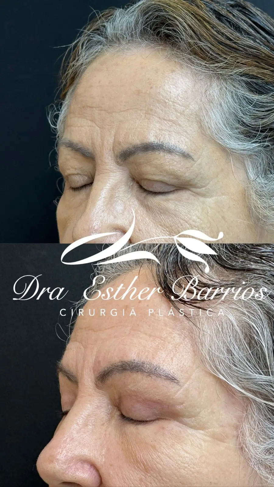 Blepharoplasty Surgery in Rio de Janeiro, Brazil by Dr. Esther Barrios — Procedure Gallery Photo