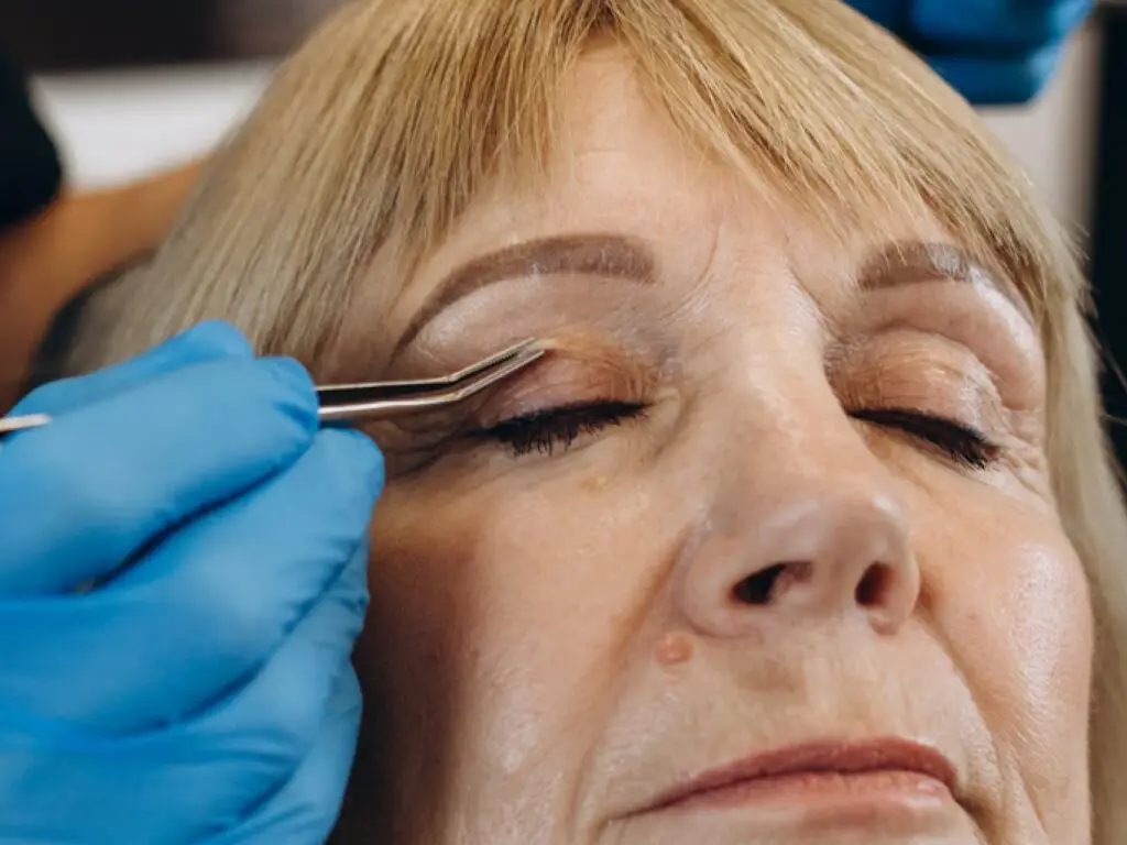 Blepharoplasty in Istanbul, Turkey by Esvita Clinic — Ophthalmology Procedure in Turkey