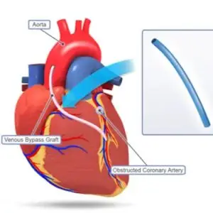 Coronary Bypass Surgery Clinics and Procedures Abroad