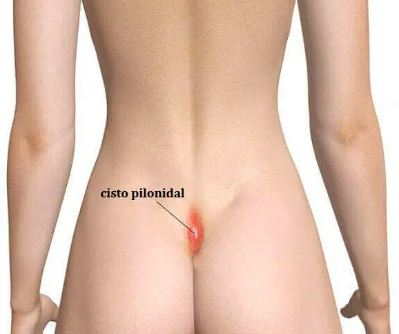 Pilonidal Cyst Surgery in Brazil by Dr. Kaiser Jr. — Procedure Gallery Photo