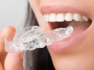 Clear Aligners in Istanbul, Turkey by Esvita Clinic at Esvita Clinic — Dentistry Procedure Abroad