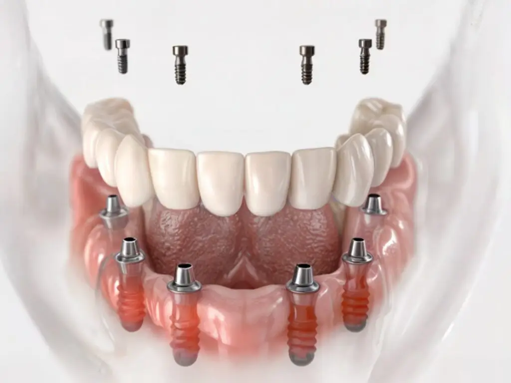 All-on-6 Treatment in Istanbul, Turkey by Esvita Clinic — Dentistry Procedure in Turkey