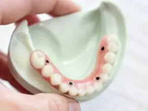 All-on-4 Treatment in Istanbul, Turkey by Esvita Clinic at Esvita Clinic — Dentistry Procedure Abroad