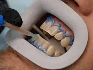 Teeth Whitening in Istanbul, Turkey by Esvita Clinic — Dentistry in Turkey