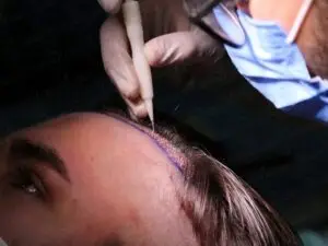 Autologous Micrograft in Istanbul, Turkey by Esvita Clinic — Hair Restoration Surgery in Turkey