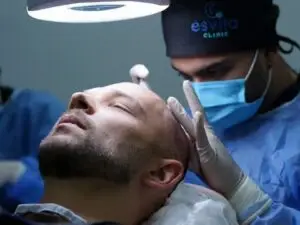 DHI Hair Transplant in Istanbul, Turkey by Esvita Clinic — Hair Restoration Surgery in Turkey