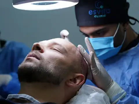 DHI Hair Transplant in Istanbul, Turkey by Esvita Clinic — Hair Restoration Surgery Procedure in Turkey