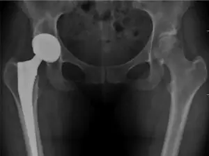 Total Hip Replacement (Hip Arthroplasty) in San José, Costa Rica by Dr. Aria Alexander Ravery Morovati at Dr. Aria Alexander Ravery Morovati — Orthopedics Procedure Abroad