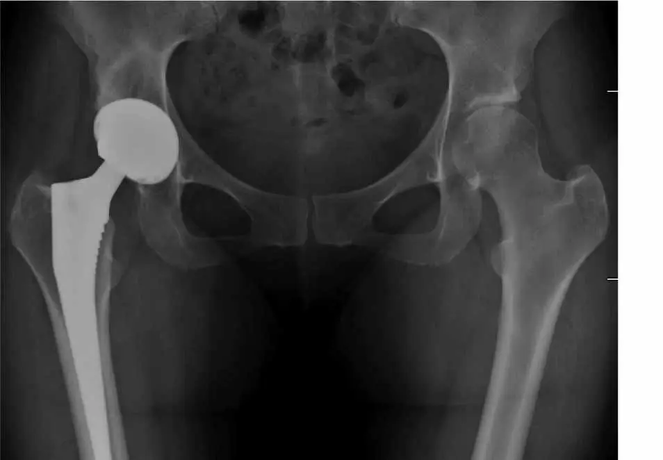 Total Hip Replacement (Hip Arthroplasty) in San José, Costa Rica by Dr. Aria Alexander Ravery Morovati — Procedure Gallery Photo