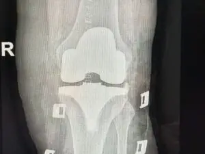 Robotic-Assisted Knee Replacement Surgery in San José, Costa Rica by Dr. Aria Alexander Ravery Morovati at Dr. Aria Alexander Ravery Morovati — Orthopedics Procedure Abroad