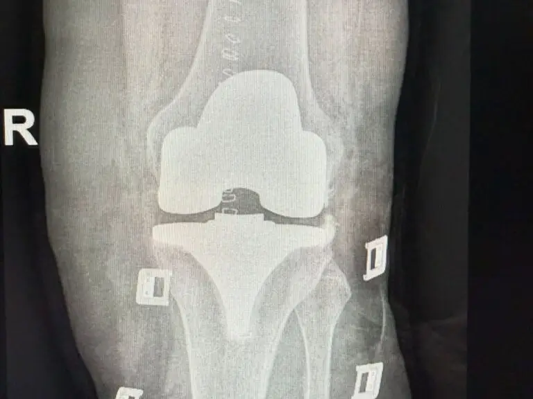 Robotic-Assisted Knee Replacement Surgery in San José, Costa Rica by Dr. Aria Ravery — Orthopedics Procedure in Costa Rica