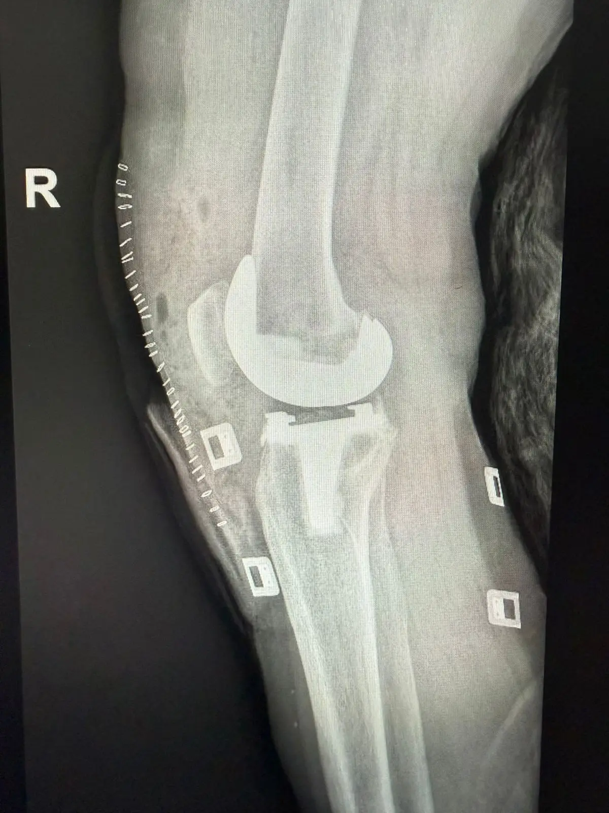 Total and Partial Knee Replacement (Knee Arthroplasty) in San José, Costa Rica by Dr. Aria Alexander Ravery Morovati — Procedure Gallery Photo